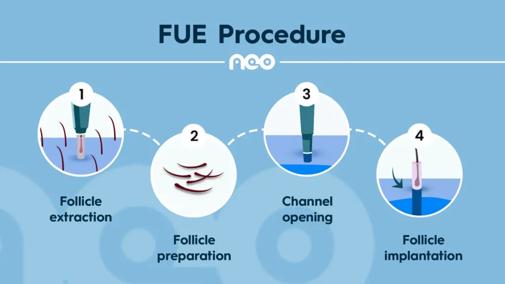 fue hair transplant